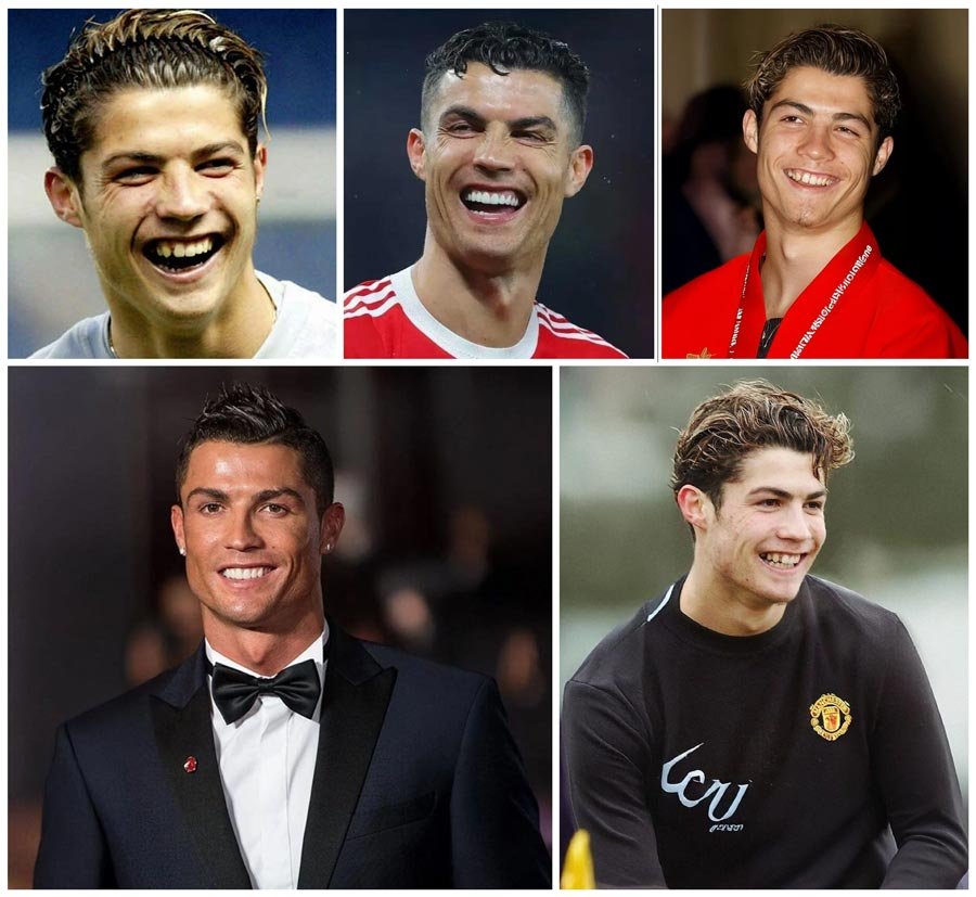 Cristiano Ronaldo Teeth Before And After Veneers