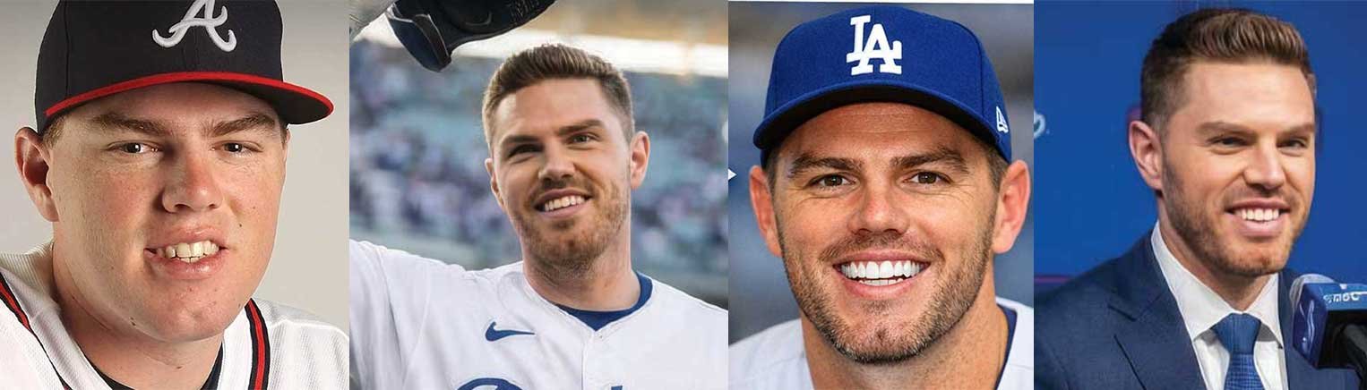 Freddie Freeman's Teeth and Veneers