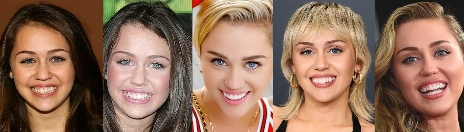 Miley Cyrus Teeth Before and After: A Hollywood Smile Journey