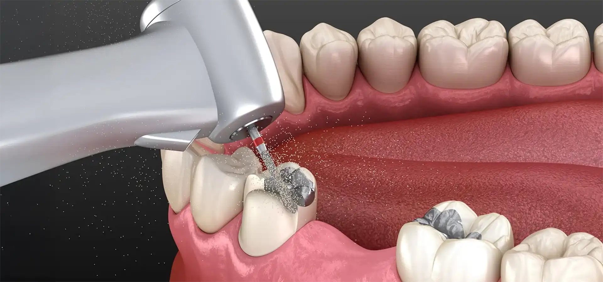 Diş Dolgusu (Amalgam / Kompozit)