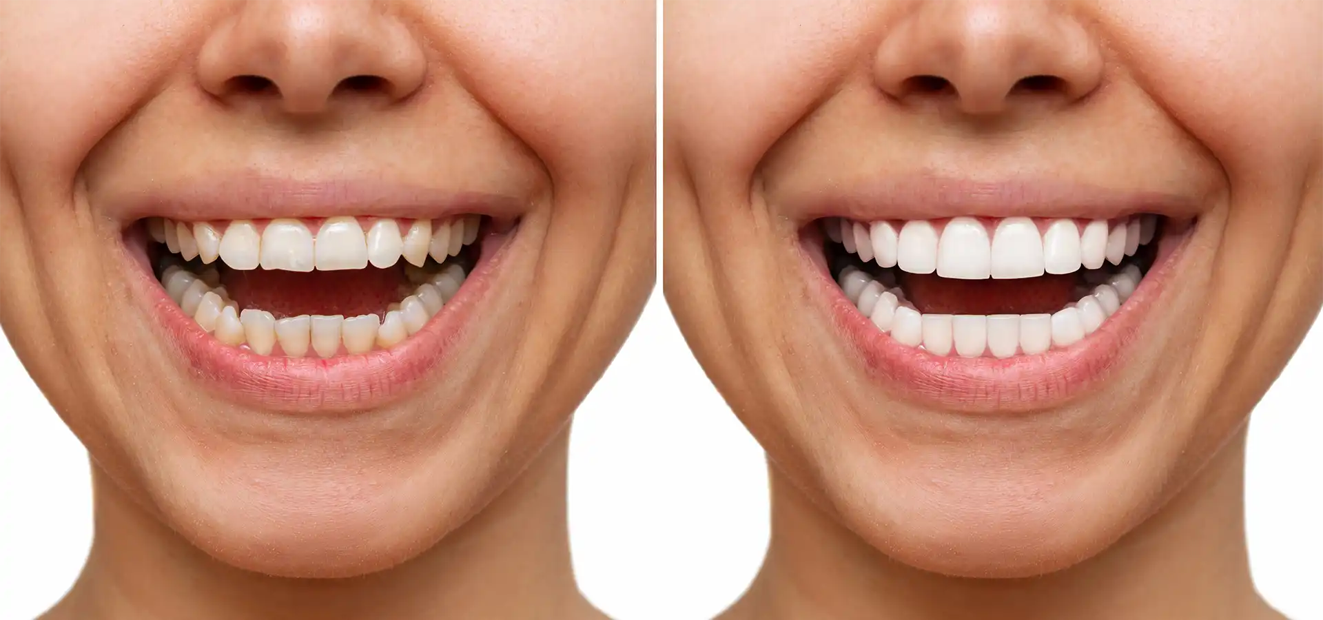 Composite Bonding in Istanbul, Turkey