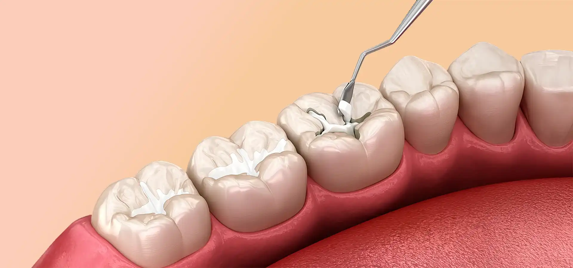 Dental Sealants in Istanbul, Turkey