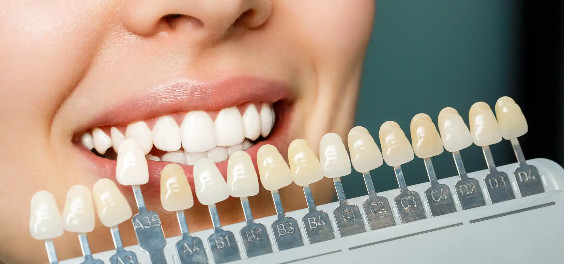 Empress Veneers in Istanbul, Turkey