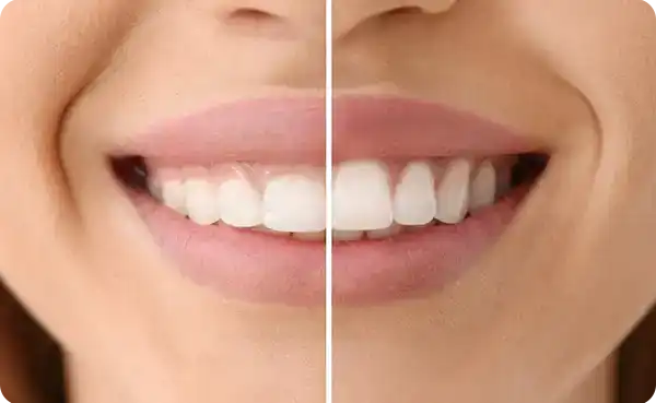 Gummy Smile Tedavisi