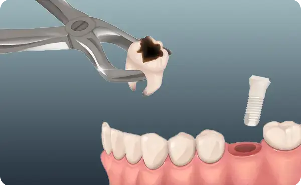 Anında İmplant Tedavisi