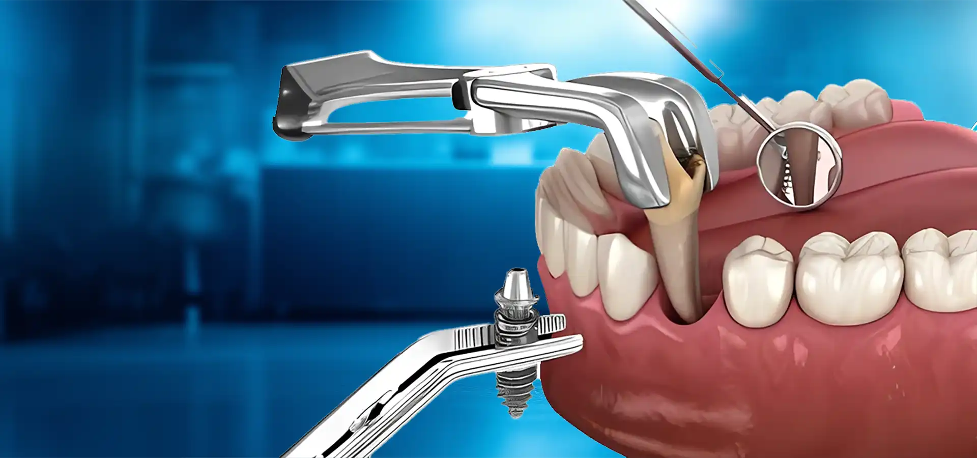 Anında İmplant Tedavisi