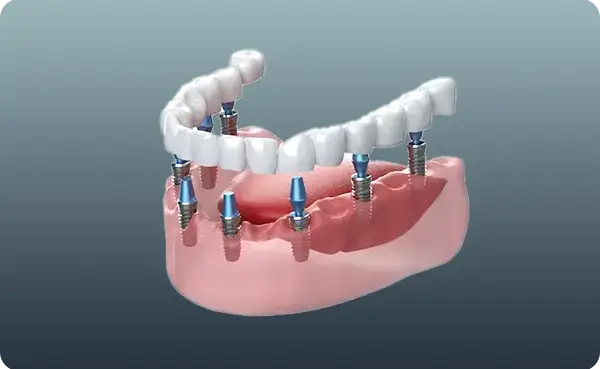 İmplant Destekli Protezler