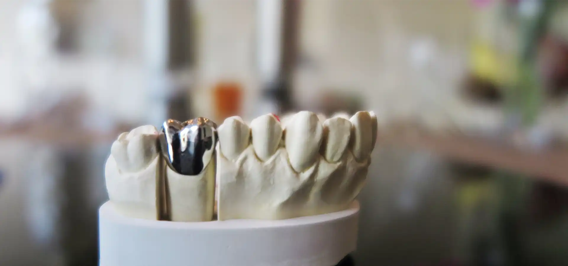 Metal Destekli Porselen Kaplama(PFM)