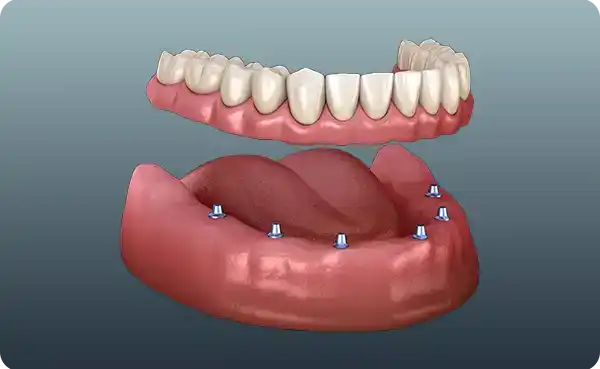 İmplant Destekli Protez