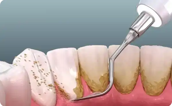 Diş Taşı Temizliği