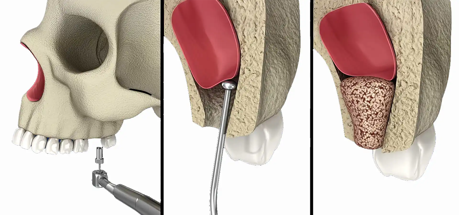 Sinus Lifting in Istanbul, Turkey