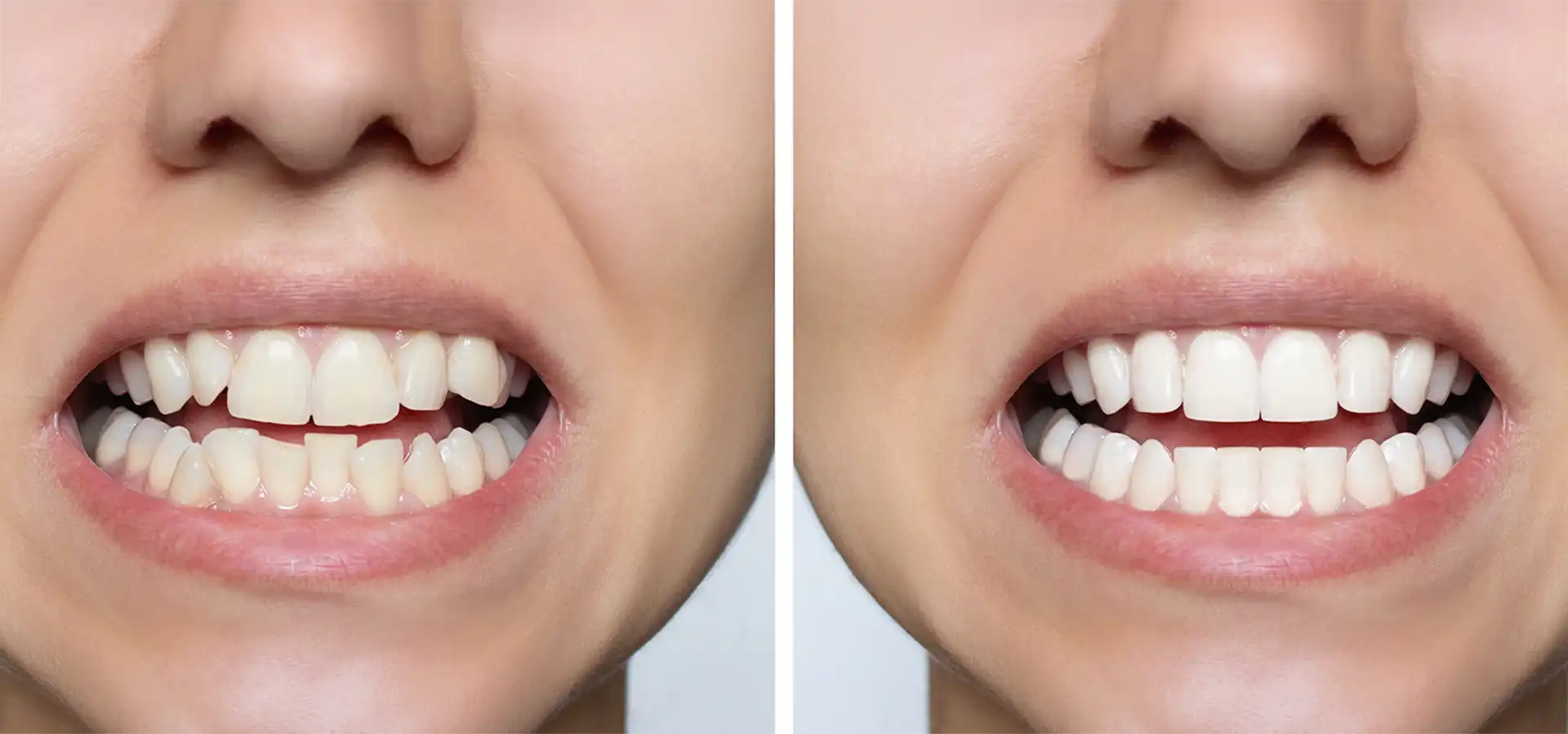Tooth Contouring & Shaping in Istanbul, Turkey