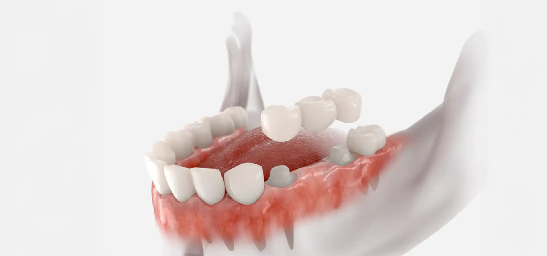 Traditional Dental Bridges in Istanbul, Turkey