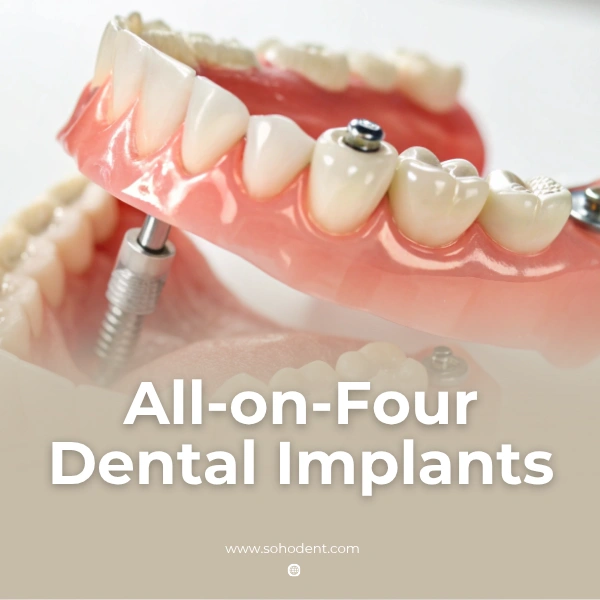 All-on-Four Dental Implants: Fast, Fixed Teeth In Turkey