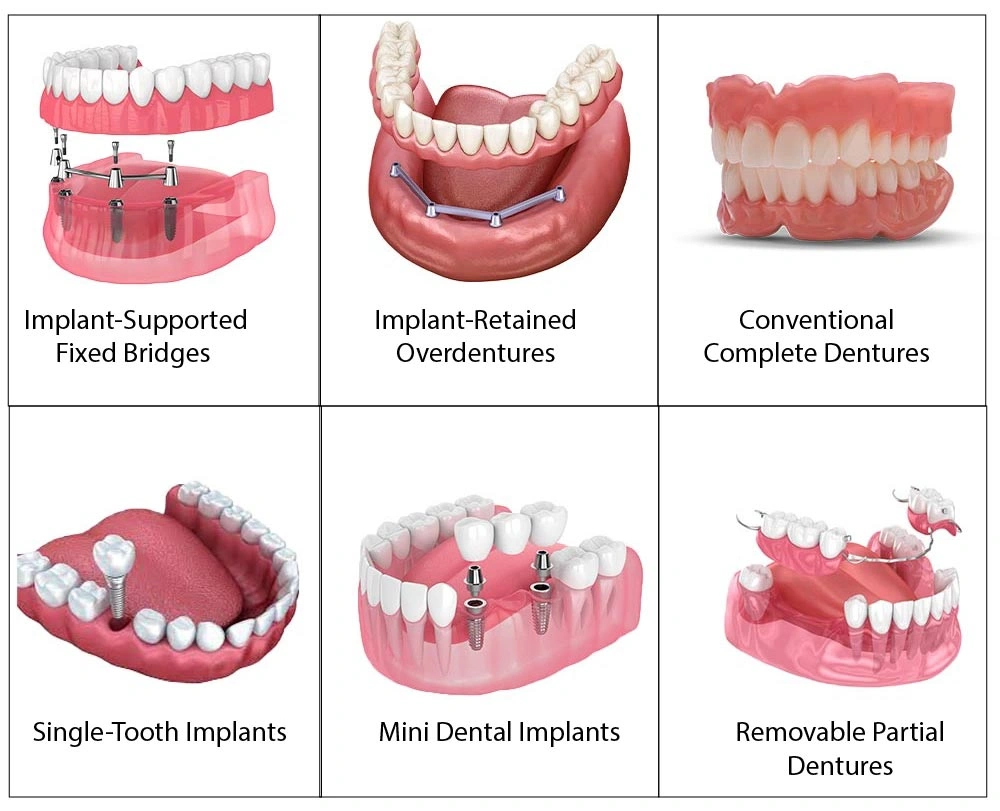 Alternatives to All-on-Four