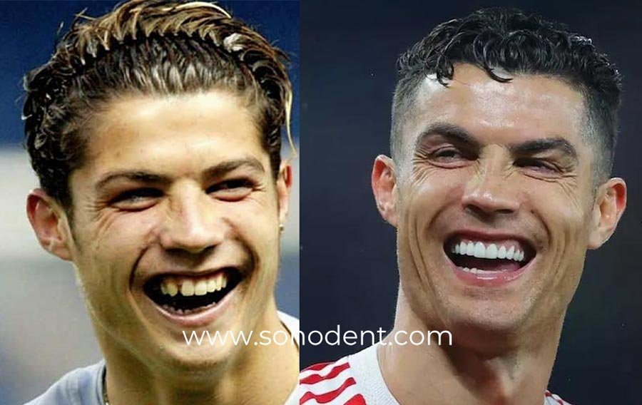 Does Cristiano Ronaldo Have Veneers