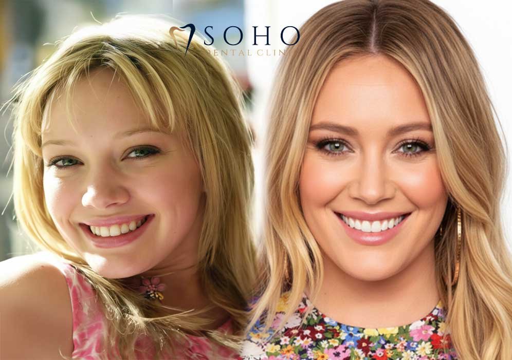 CELEBRITY VENEERS BEFORE AND AFTER TRENDS