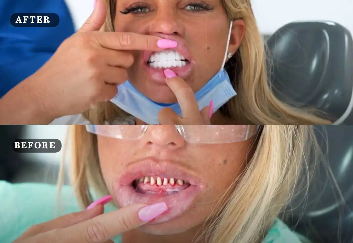 Katie Price Teeth Before and After Photos