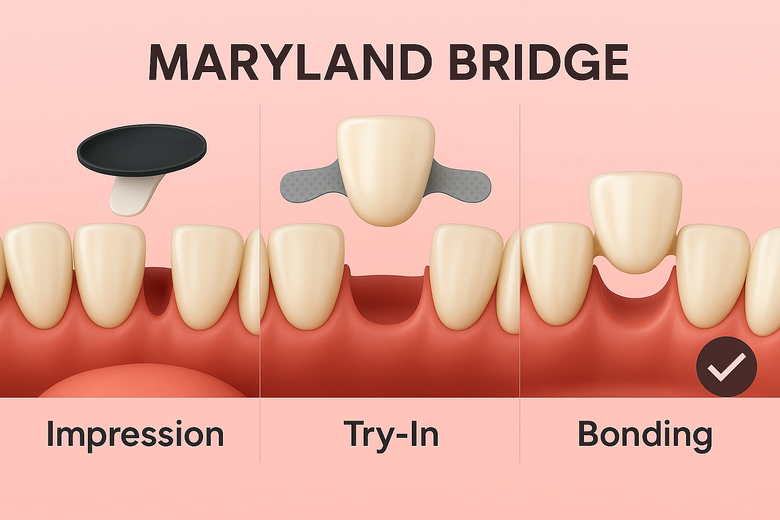 How the Maryland Bridge Procedure Is Performed best price