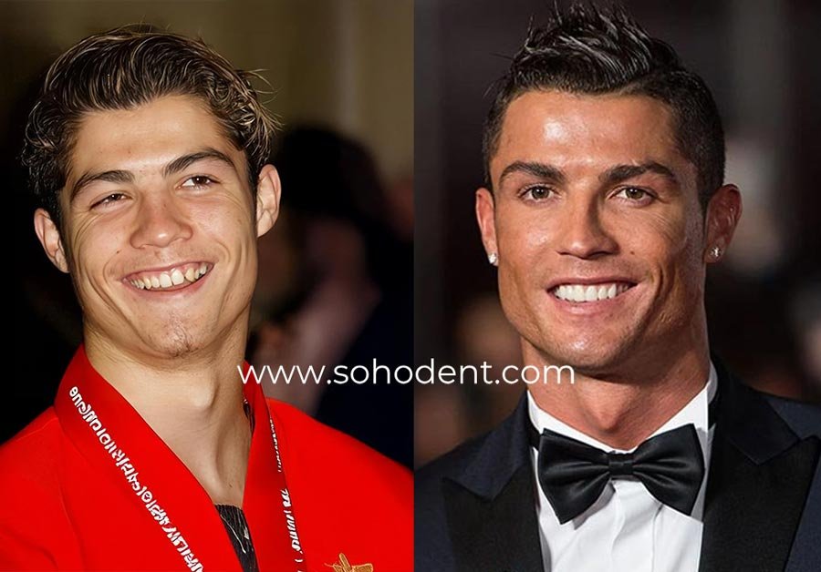 Ronaldo Teeth Before after