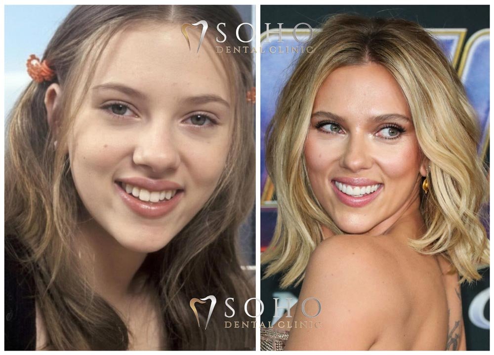 scarlett johansson teeth smile