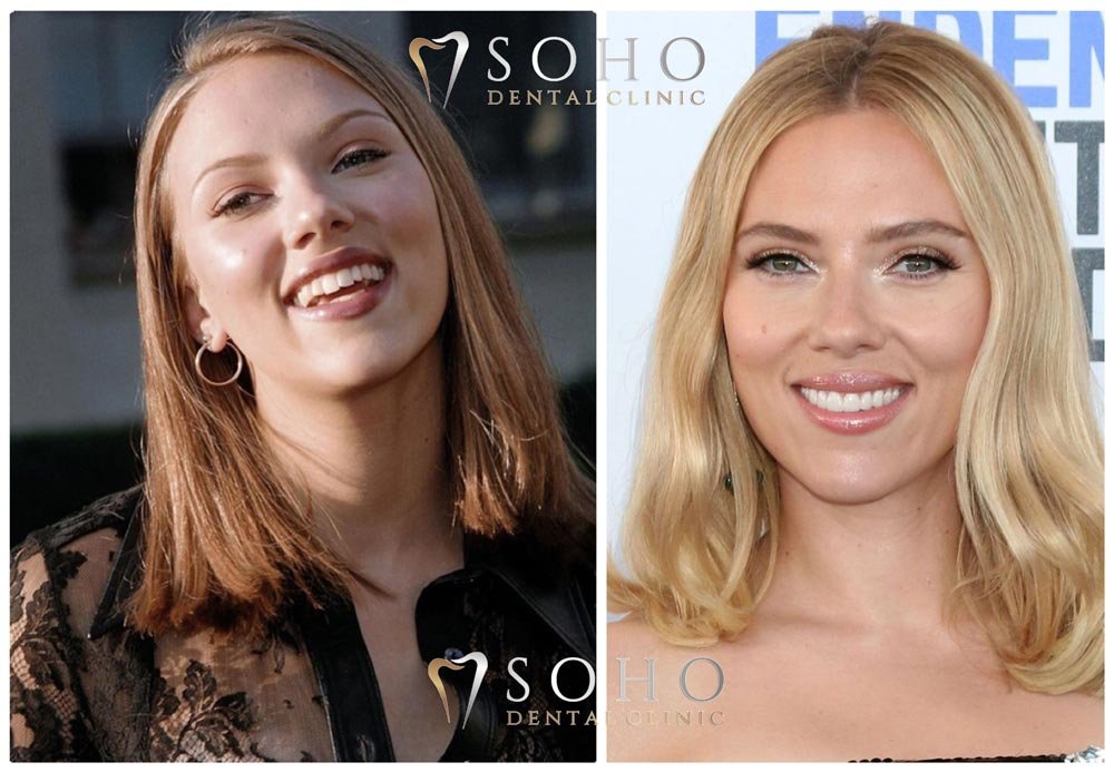 scarlett johansson teeth before and after