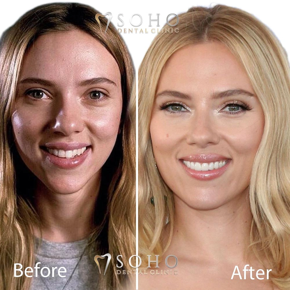 Scarlett Johansson’s teeth veeners