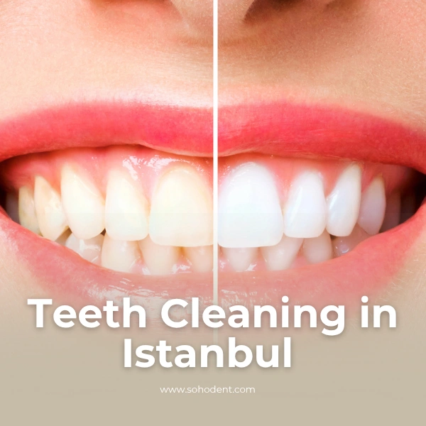 Teeth Cleaning in Istanbul best price