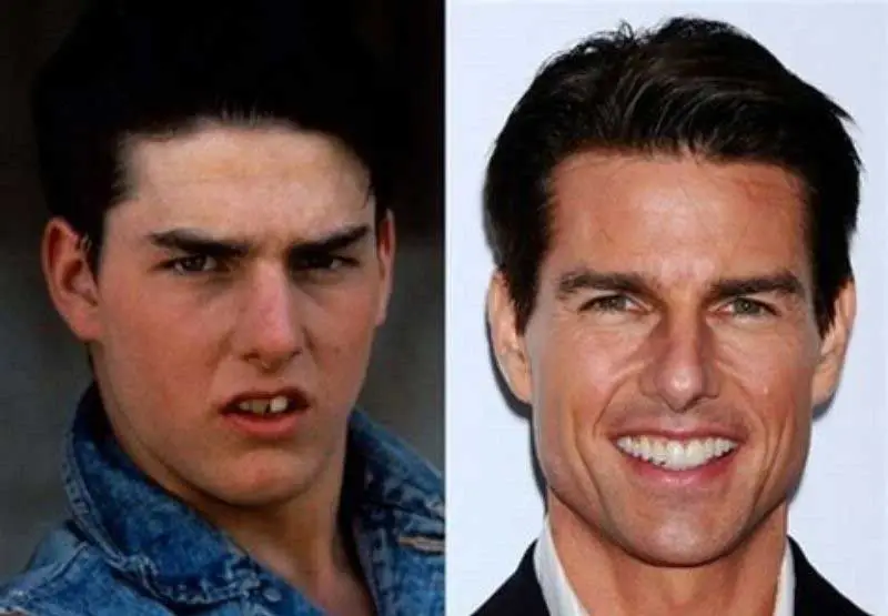 tom cruise middle tooth