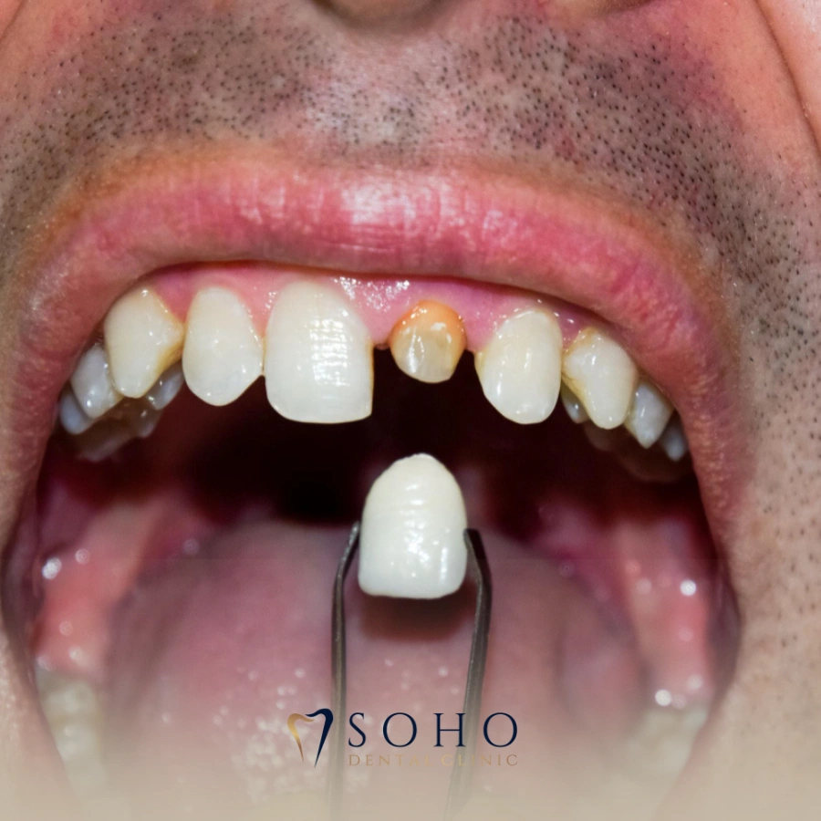 how much does it cost to reattach a crown