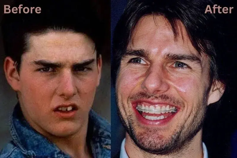 Tom Cruise Teeth Before After, Smile Evolution