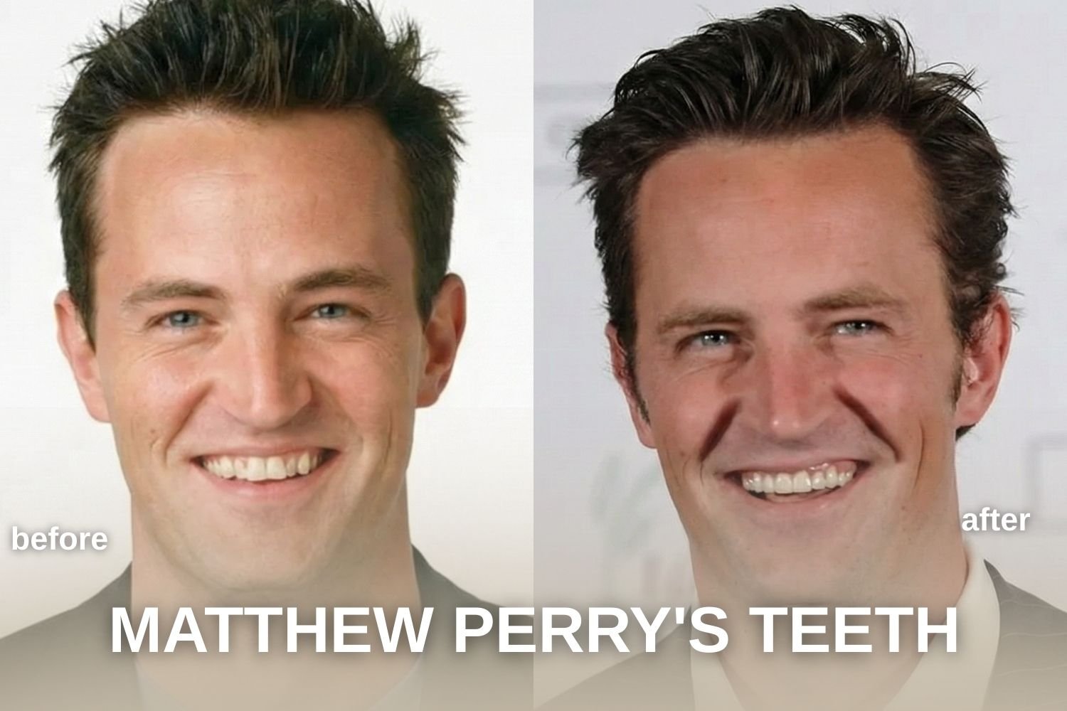 Matthew Perry's Teeth Transformation