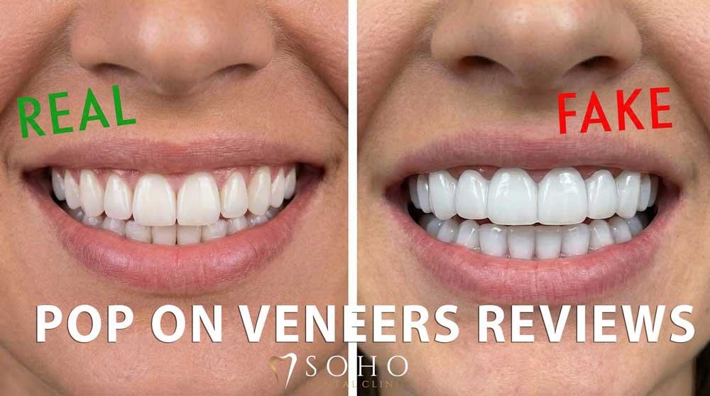 pop on veneers reviews