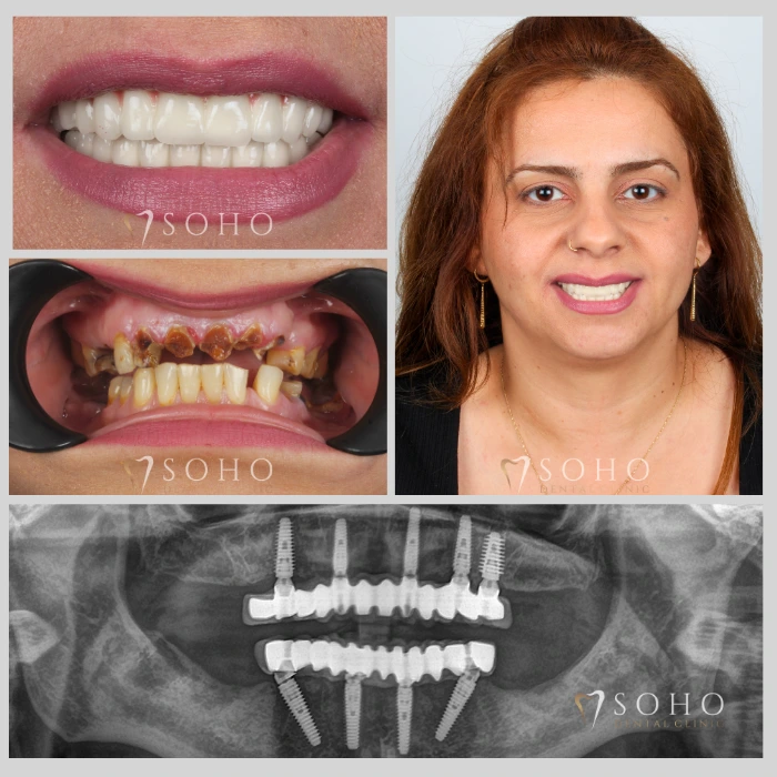 Before and after all on 4 dental implants