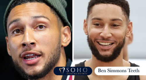 ben-simmons-teeth