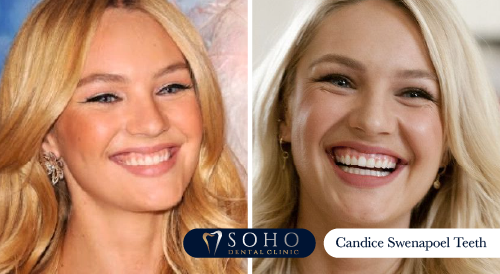 Candice Swenapoel Teeth