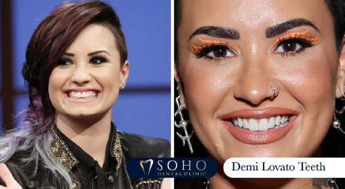 demi-lovato-before-and-after-teeth-gap