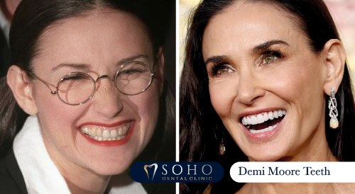 Demi Moore Teeth