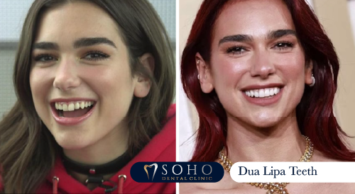 dua lipa teeth before and after