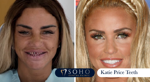 Katie Price Teeth