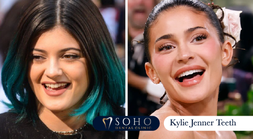 kylie-enner-teeth