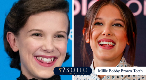 Millie Bobby Brown Teeth