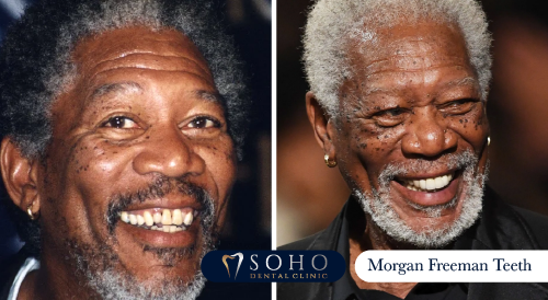 Morgan Freeman Teeth