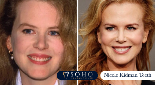 nicole-kidman-teeth