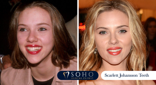 Scarlett Johansson Teeth