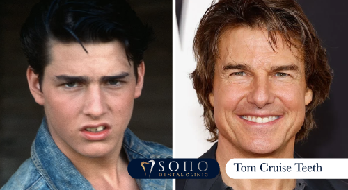 tom-cruise-teeth