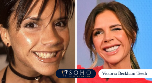 victoria-becham-teeth
