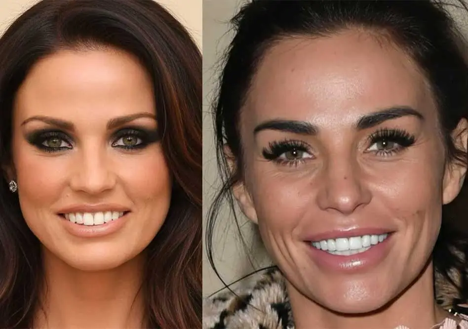 Katie Price Turkey Teeth Trend