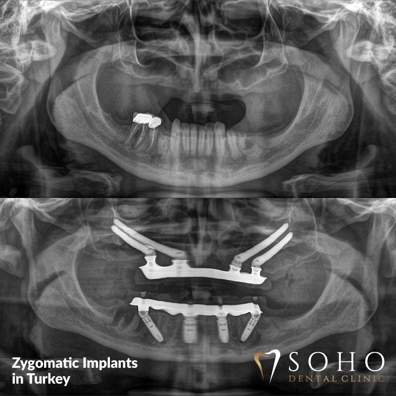 Zygomatic and Pterygoid (Cheekbone) Implants in istanbul - dental implants in cheekbone
